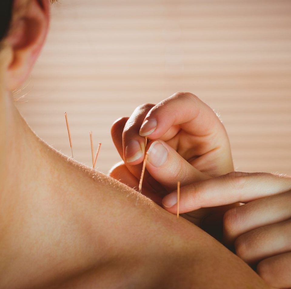 Dry Needling